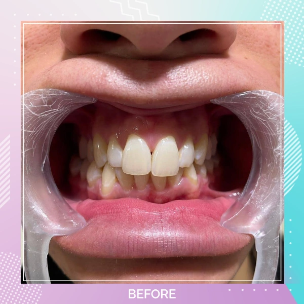 Composite Bonding patient 4 B 1