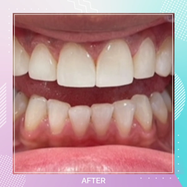 Composite Bonding patient 5 A 1