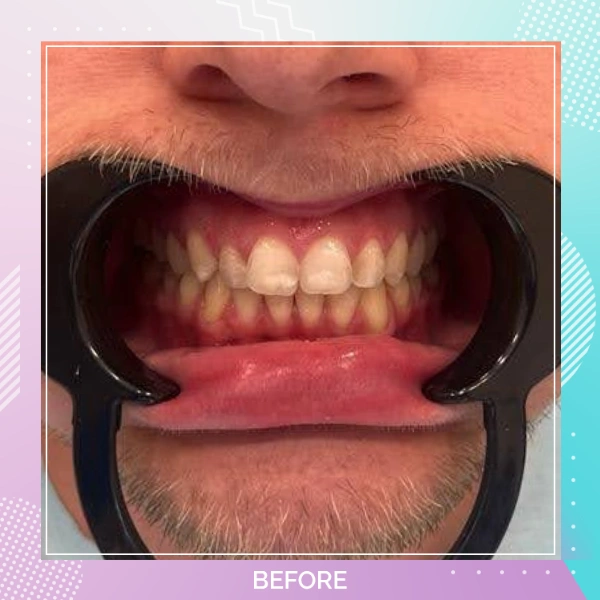 Composite Bonding patient 6 B 1