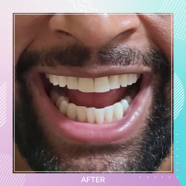 Composite Bonding patient 7 A 1