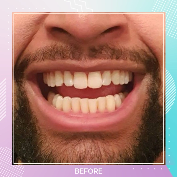 Composite Bonding patient 7 B 1