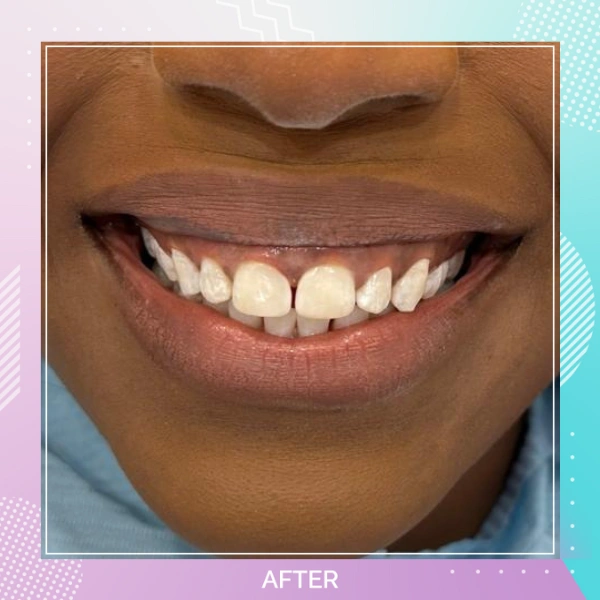 Composite Bonding patient 8 A 1