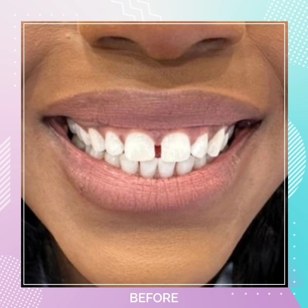 Composite Bonding patient 8 B 1
