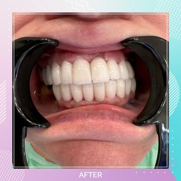 Dental Crowns patient 10 A 1