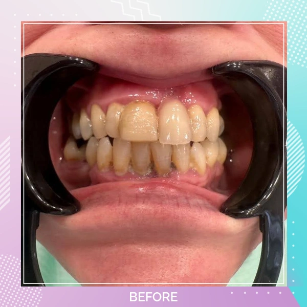 Dental Crowns patient 10 B 1