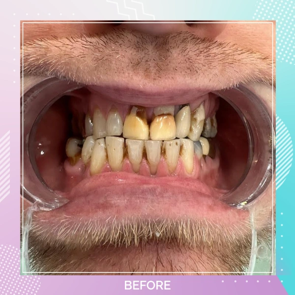 Dental Crowns patient 13 B Hollywood smile
