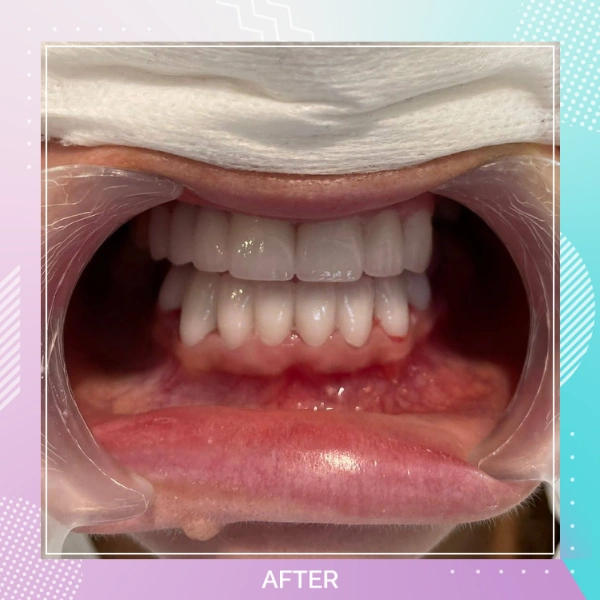 Dental Crowns patient 14 A Hollywood smile