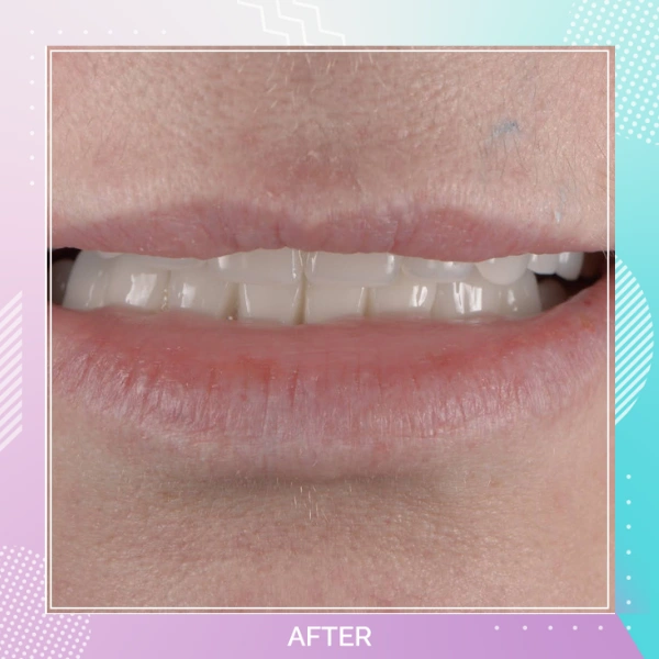 Dental Crowns patient 15 A 1