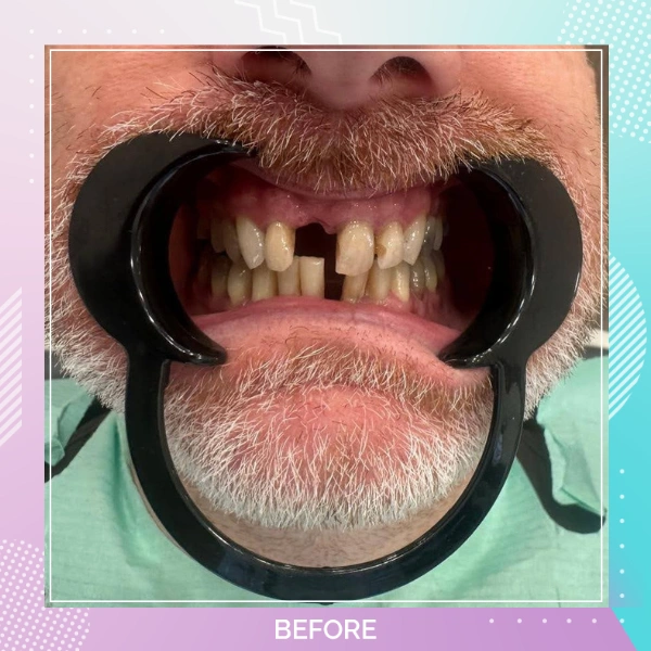 Dental Crowns patient 16 B 1