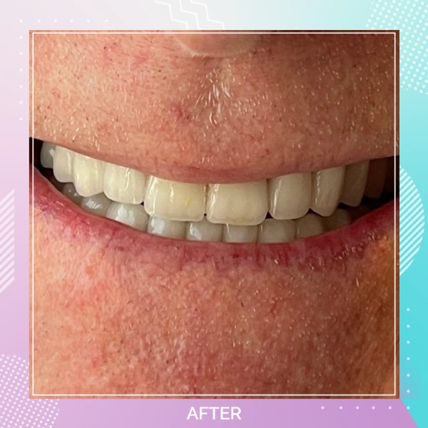Dental Crowns patient 2 A 1