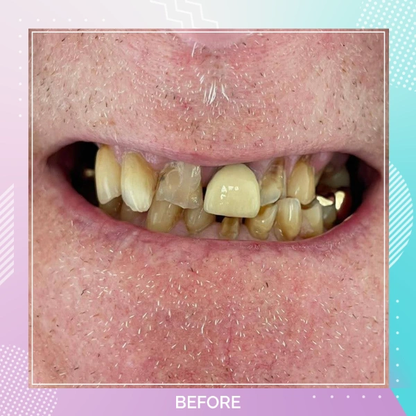 Dental Crowns patient 2 B 1