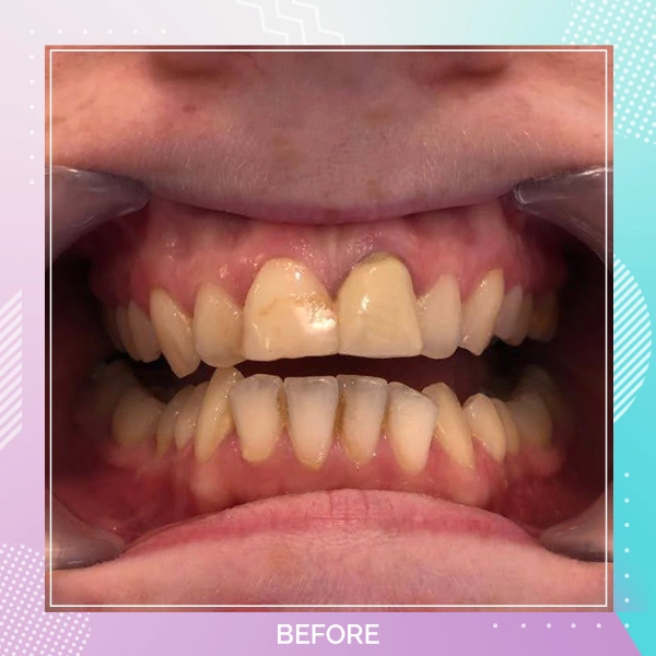 Dental Crowns patient 3 B 1
