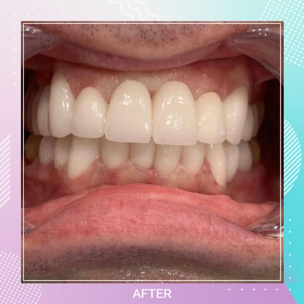 Dental Crowns patient 4 A 1