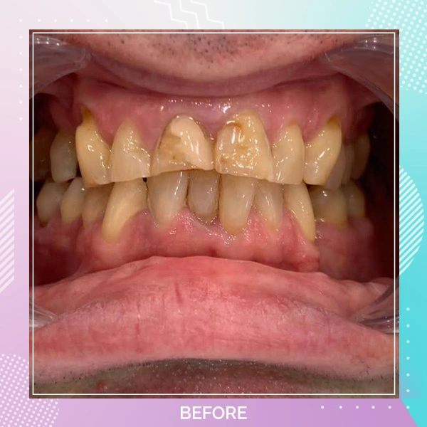 Dental Crowns patient 4 B 1
