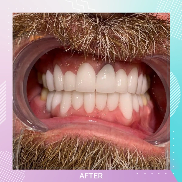 Dental Crowns patient 5 A 1