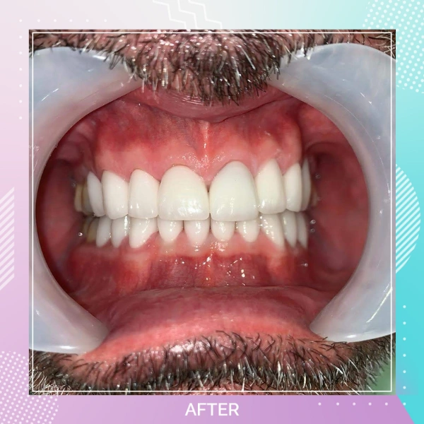 Dental Crowns patient 9 A 1