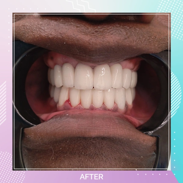 Dental Implants patient A 2