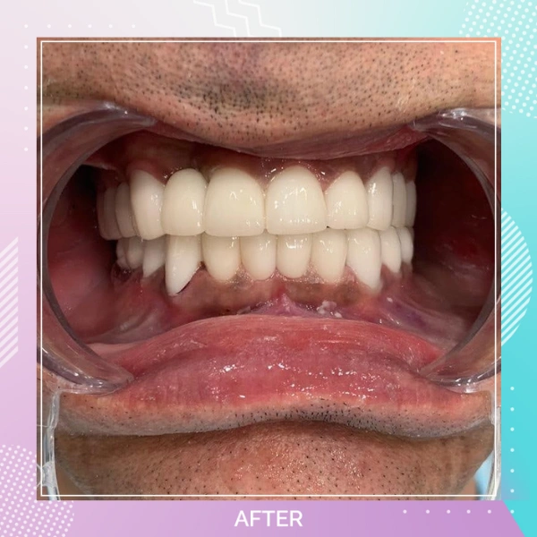 Dental Implants patient A 3