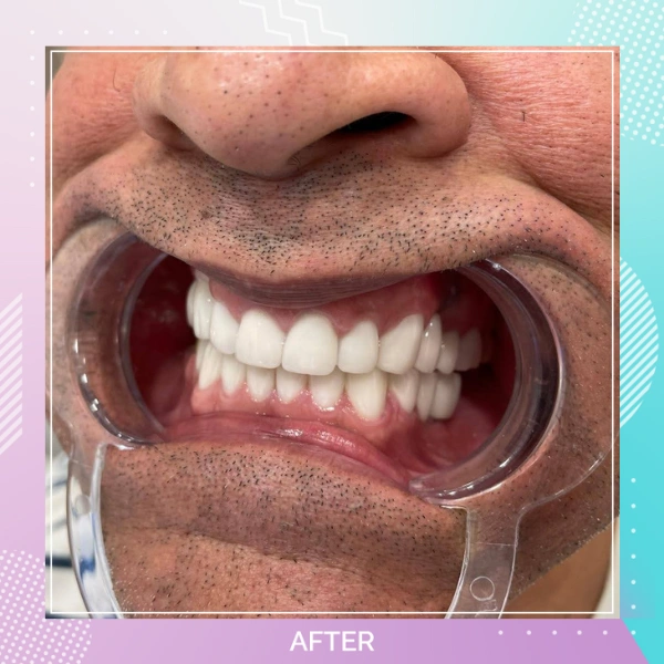 Dental Implants patient A 4