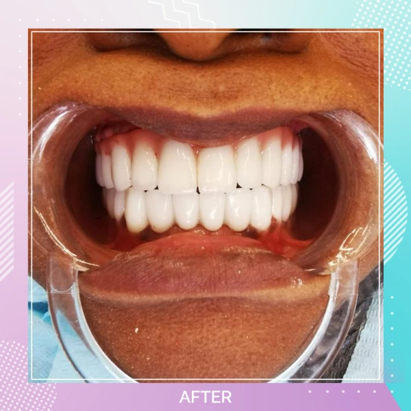 Dental Implants patient A 6