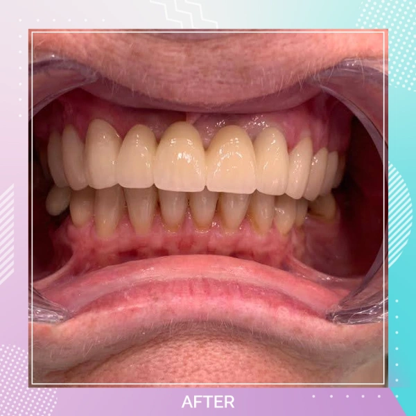 Dental Implants patient A 7