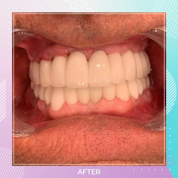 Dental Implants patient A 8
