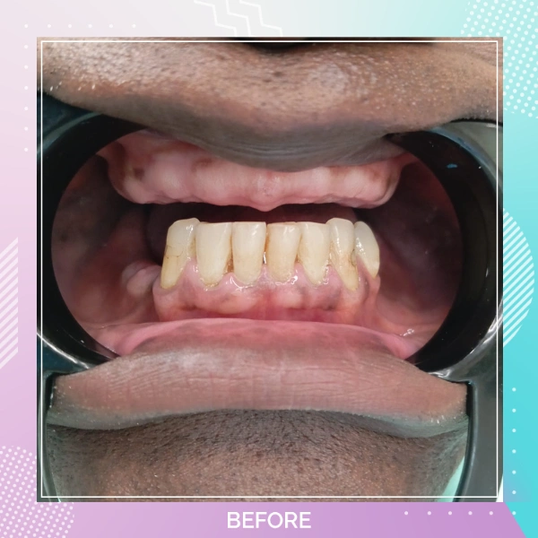 Dental Implants patient B 2