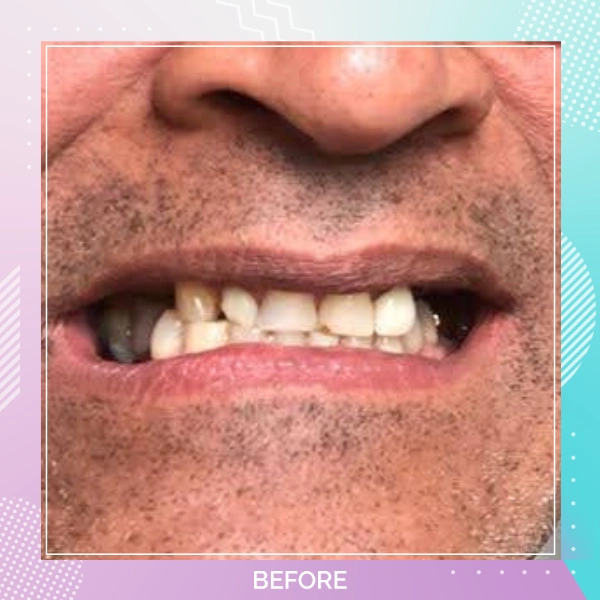 Dental Implants patient B 4