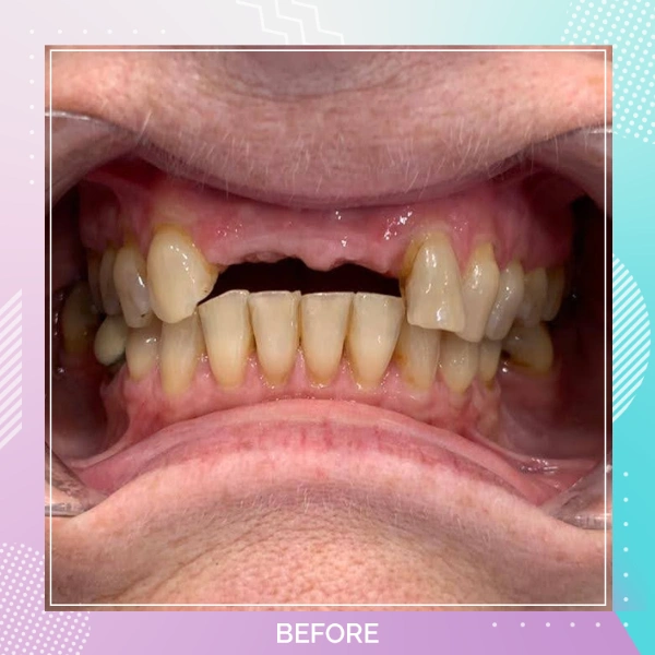 Dental Implants patient B 7