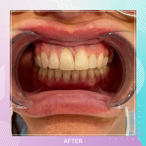 Dental Veneers patient 2 A 1