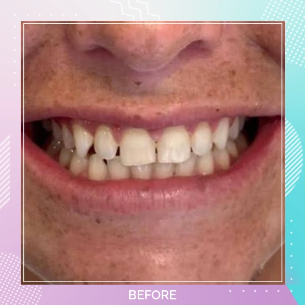 Dental Veneers patient 5 B Hollywood Smile