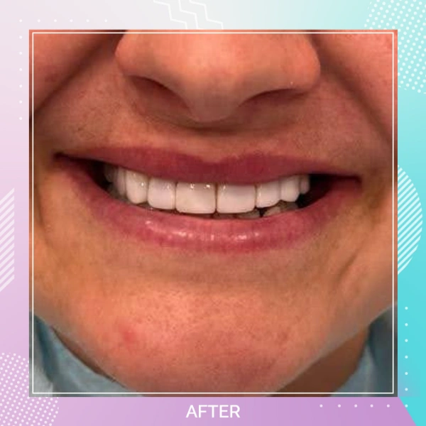 Dental Veneers patient 6 A 1