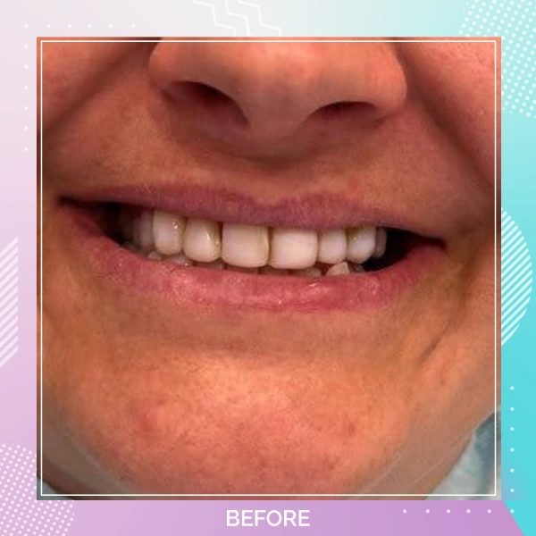 Dental Veneers patient 6 B 1