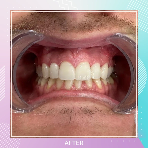 Dental Veneers patient 8 A 2
