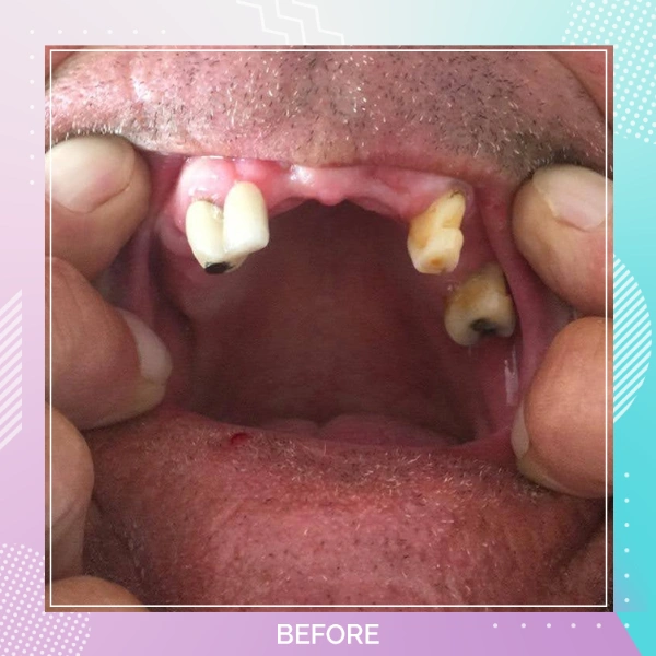 Implant Patient 7 Before