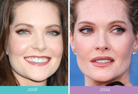 Dentist Weighs In On White Lotus Meghann Fahy’s Smile Transformation