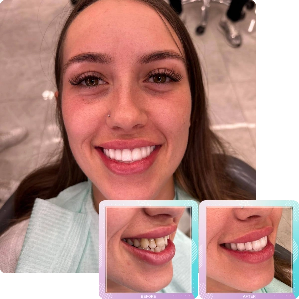 Dental crowns before and after smile transformation