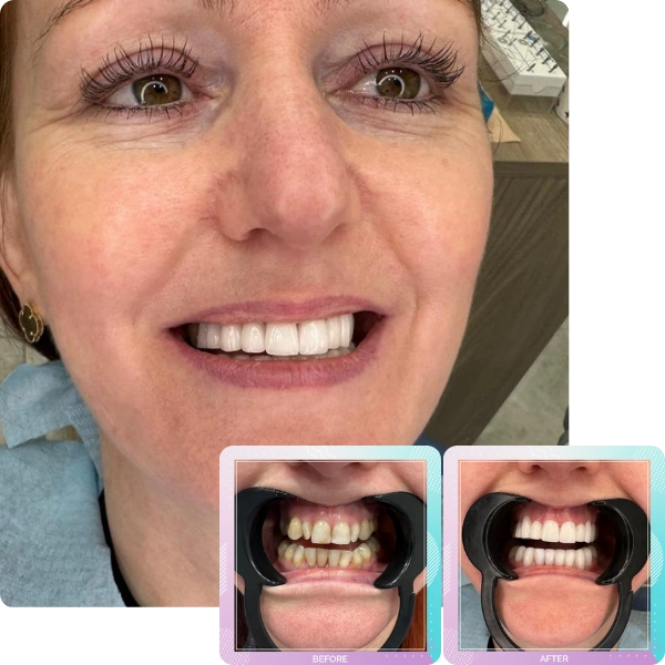 Smile gallery patient 10