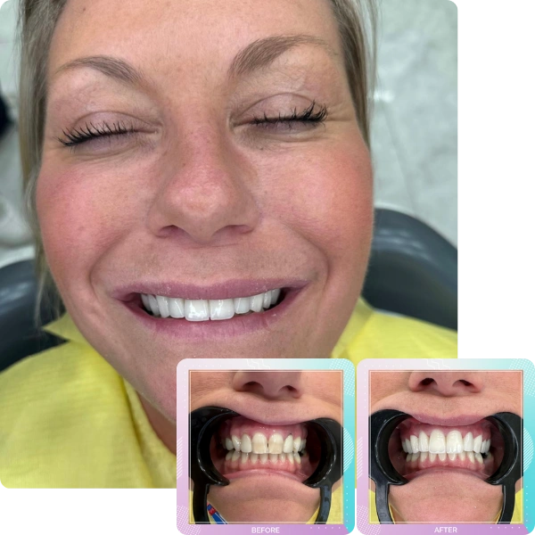 Dental crowns before and after smile transformation
