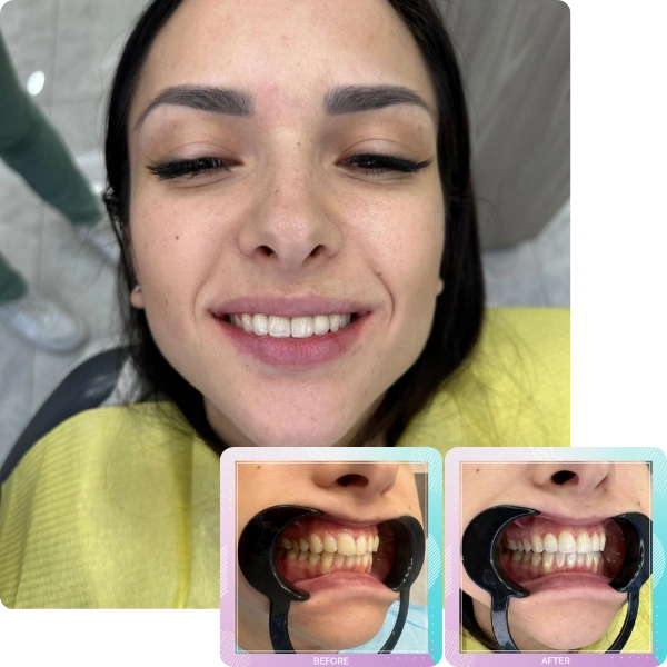 Dental crowns before and after smile transformation