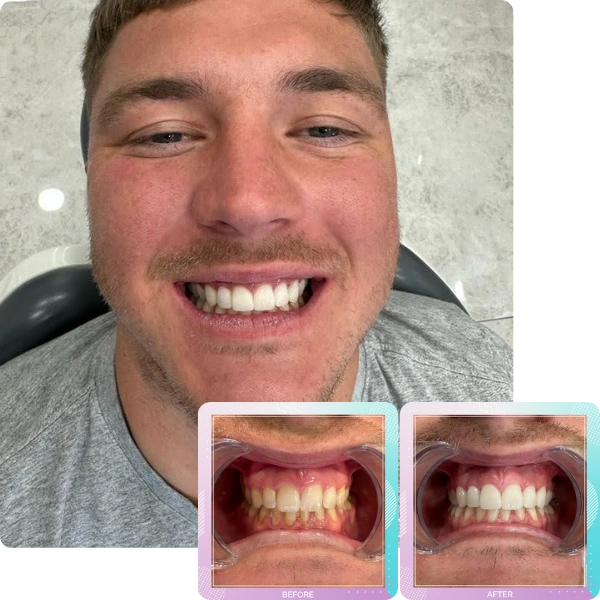 Dental veneers before and after smile transformation