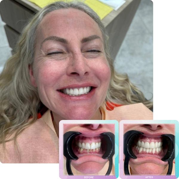 Dental crowns before and after smile renewal