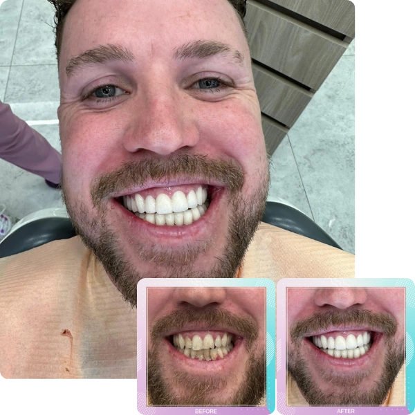 Dental crowns before and after smile transformation