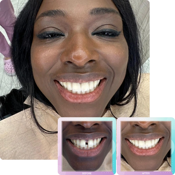 Dental crowns before and after smile transformation