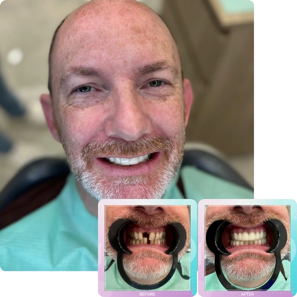 Dental crowns before and after smile transformation