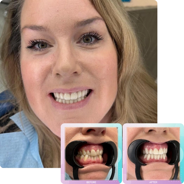 Dental crowns before and after smile transformation