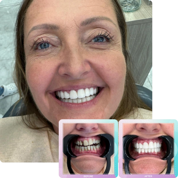 Smile gallery patient 8