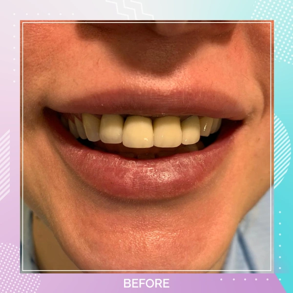 Teeth Whitening patient 1 B 1
