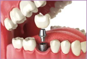 dental implants mouth