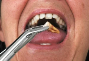 tooth extraction 1